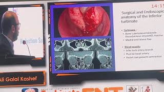 Turbinoplasty Vs Turbinectomy \ Basic ENT Conference ElKasr ElAiny [upl. by Illil]