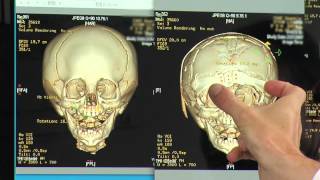 Craniosynostosis Treatment Options for Metopic amp Unilateral Coronal Synostosis  Part 6 of 6 [upl. by Silvana]