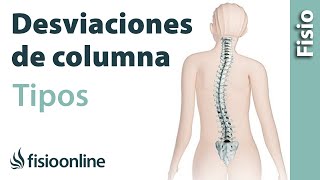 ¿Tipos de desviaciones de la columna [upl. by Yusem]