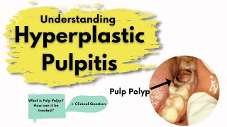 Pulp Polyp Hyperplastic Pulpitis  What is it  Diagnosis Treatment  Endodontics [upl. by Amling]