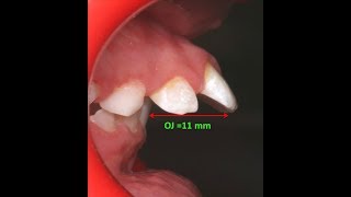 Amazing two phase treatment of Sever Class II Div 1  lama 10Y [upl. by Natalie]