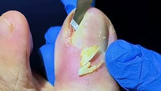 Big Hole on Big Toe After Huge Ingrown Toenail Removal [upl. by Ardnaet52]