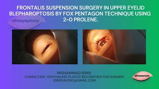 Frontalis suspension surgery in upper eyelid blepharoptosis using 20 prolene [upl. by Vivianna]