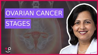 The 4 Stages of Ovarian Cancer by Dr Ruchi Garg [upl. by Analram216]