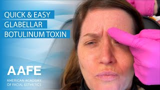 Quick amp Easy Glabellar Botulinum Toxin Injection [upl. by Staffan63]