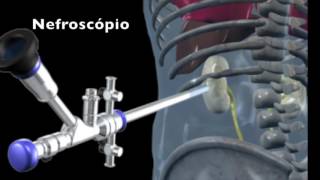 Cirurgia Percutânea do Rim  Nefrolitotripsia percutânea [upl. by Ramaj238]