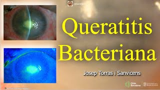 Queratitis Bacteriana [upl. by Drahser]