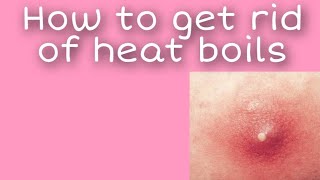 Home remedies to get rid of heat boils [upl. by Kristo]