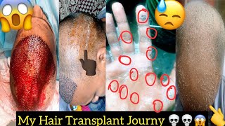 Hair Transplant Scars What to Expect and How to Minimize Them l My Hair Transplant Experience [upl. by Neelrahc253]