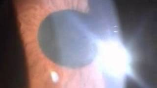 uveitis with hypopyon [upl. by Romina]