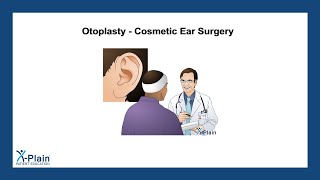 Otoplasty  Cosmetic Ear Surgery [upl. by Alessig]