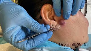 Drainage of an infected cyst in front of the ear [upl. by Nicko]