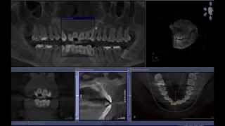 Nasopalatine Duct Cyst  Cone beam computed tomography [upl. by Mailiw905]