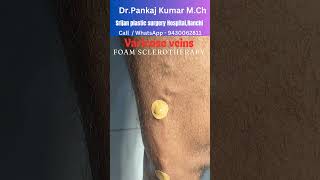 Foam Sclerotherapy for varicose veins Varicose veins treatment for SSC GD medical [upl. by Nnairrek]