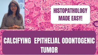 CALCIFYING EPITHELIAL ODONTOGENIC TUMOR  PART2  HISTOPATHOLOGY MADE EASY I ORAL PATHOLOGY [upl. by Kaczer]