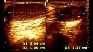 Cryptorchidism in children  Testicular Microlithiasis  Undescended testis [upl. by Ynnek]