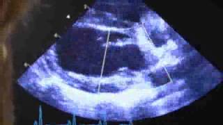 Echocardiography Common views 14  Interest of Echocardiography [upl. by Yesnyl]