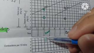 How To Diagnosis Prolonged and Obstructed Labour in Partograph [upl. by Aldis]