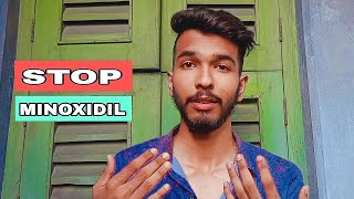 6 months minoxidil beard growth journey results review how to grow beard 🪴 minoxidil beard [upl. by Inalem310]