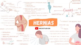 What are hernias  Direct and Indirect  MedStudier [upl. by Wilda896]