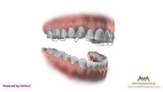 Orthodontic Retainer  Hawley  Instruction and Care [upl. by Aciram]