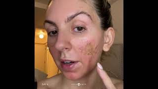 How to get rid of warts on face skincare shortvideo health doctor [upl. by Blakely399]