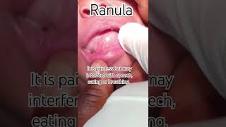 Lingual Bubble ranula oralpathology education salivarycyst health dentistryknowledge tongue [upl. by Arni]