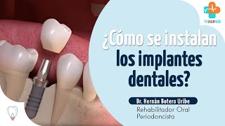 ¿Cómo se instalan LOS IMPLANTES DENTALES Tu Salud Guía [upl. by Coriss]