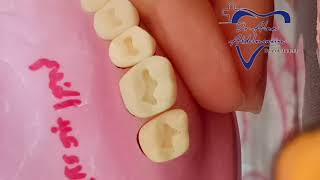 class 1 cavity preparation for upper 6 for amalgam restoration  شرح بسيط ومفصل بالعربي [upl. by Fennie7]