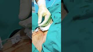 central line insertion steps femoral line insertion procedure central line kaise dalte hain [upl. by Atnima898]