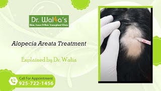 Alopecia Areata Treatment I How To Stop Alopecia Areata From Spreading [upl. by Enawtna430]