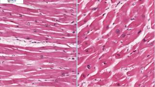 Left ventricular hypertrophy Talking Slide [upl. by Carbrey111]