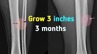 Naturally  Breaking bones after puberty to grow tall  100 working method [upl. by Alyahsal]