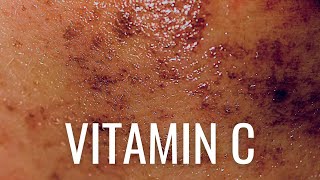 HOW Vitamin C PREVENTS Hyperpigmentation [upl. by Novihc]