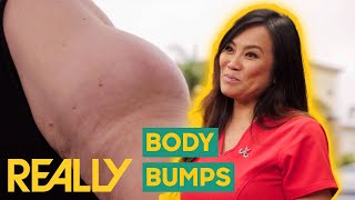 Dr Lee Helps Patients With Body Bumps All In The SAME DAY  Dr Pimple Popper Pop Ups [upl. by Gerhan]