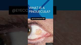 what is a pinguecula ¦eyecognizance [upl. by Astrahan135]