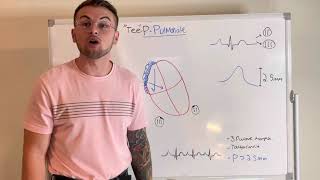 EKG Series PPulmonale Right Atrial Enlargement [upl. by Miza651]