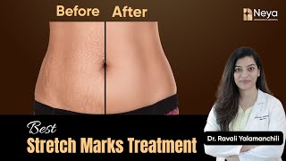 How to get rid of Stretch Marks  Stretch Marks Treatment  Stretch marks treatment in Hyderabad [upl. by Tallula]