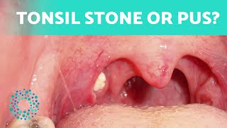 The Difference Between TONSIL STONES and TONSILITIS 👄 How to Tell Them Apart [upl. by Barn]