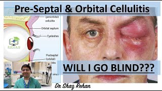 Cellulitis Learn All About PreSeptal amp Orbital Cellulitis I Dr Shaz Rehan 2023 [upl. by Lyrahs]