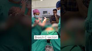 Breech Cesarean Section breechbaby cesareanbirth csection babyoutcome delivery [upl. by Frech]