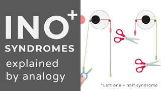 Internuclear Ophthalmoplegia INO Plus Syndromes WEBINO One and a half  Animated Explanation [upl. by Ahseet]