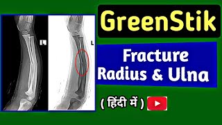 GreenStick Fracture of Radius amp Ulna  GreenStick Fracture in Children  XRay ForeArm  UdayXray [upl. by Hamrnand500]