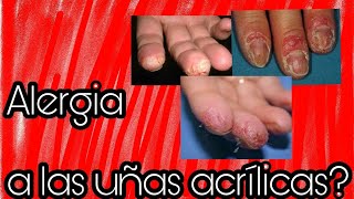 😪Alergias a las uñas acrílicas Mi experiencia👆 [upl. by Rinaldo862]