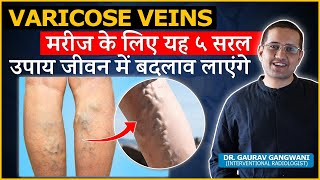 5 Simple Lifestyle Changes To Prevent Varicose Veins  Dr Gaurav Gangwani IR [upl. by Cohe]