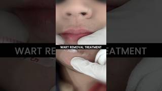 How to Get Wart Removed Treatment and Procedure at Skinaa Clinic viral shorts [upl. by Nahgiem]