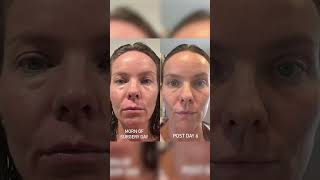 Patients Before and After Explant Procedures  Dr Kevin Brenner [upl. by Bergmann436]