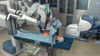 Medical Animations of Robotic Surgery [upl. by Lesak]