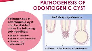 Pathogenesis of Odontogenic Cyst [upl. by Akenal]