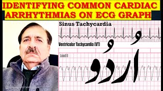 Identifying Common cardiac arrhythmias on ECG graph  Lectures by Dr Alamzeb [upl. by Siravaj697]